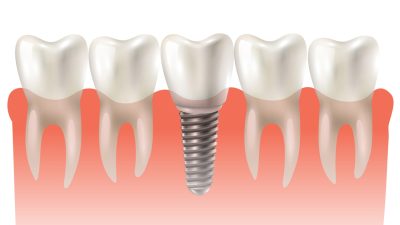 Dental implant model closeup cut away side view educative medical poster vector illustration