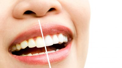 clareamento dental